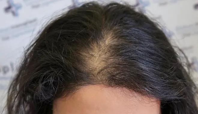 O cabelo fino também afecta as mulheres