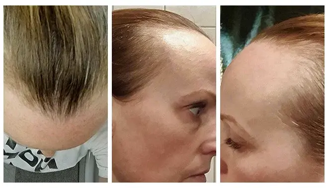 Diagnóstico de queda de cabelo em mulheres com Elithair