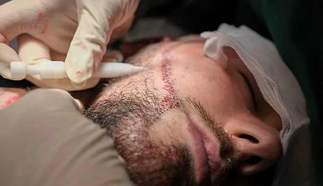 Doente durante a sua operação de transplante de barba