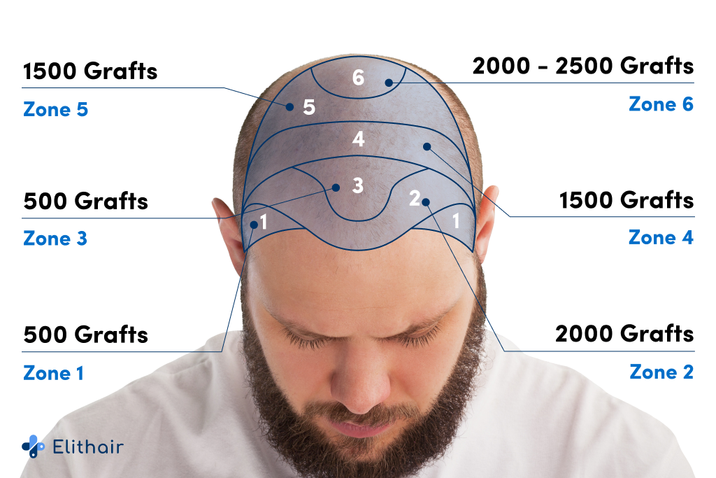 Gráfico do número de enxertos por zona para transplante de cabelo