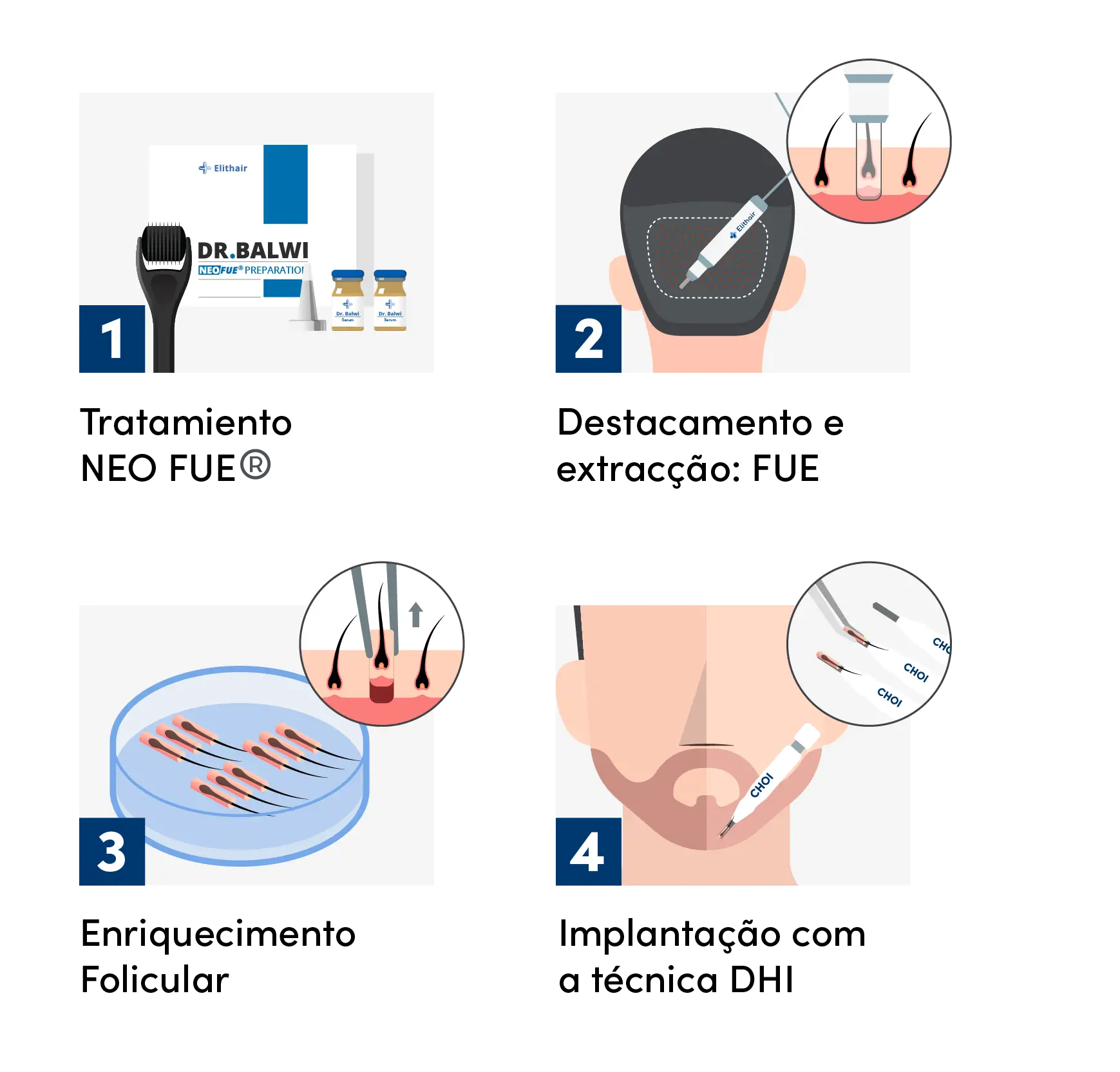 Ilustração do procedimento de um transplante capilar DHI