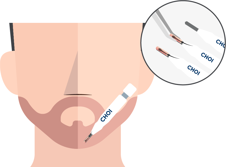 Ilustração da inserção de enxertos com a técnica DHI para um transplante de barba